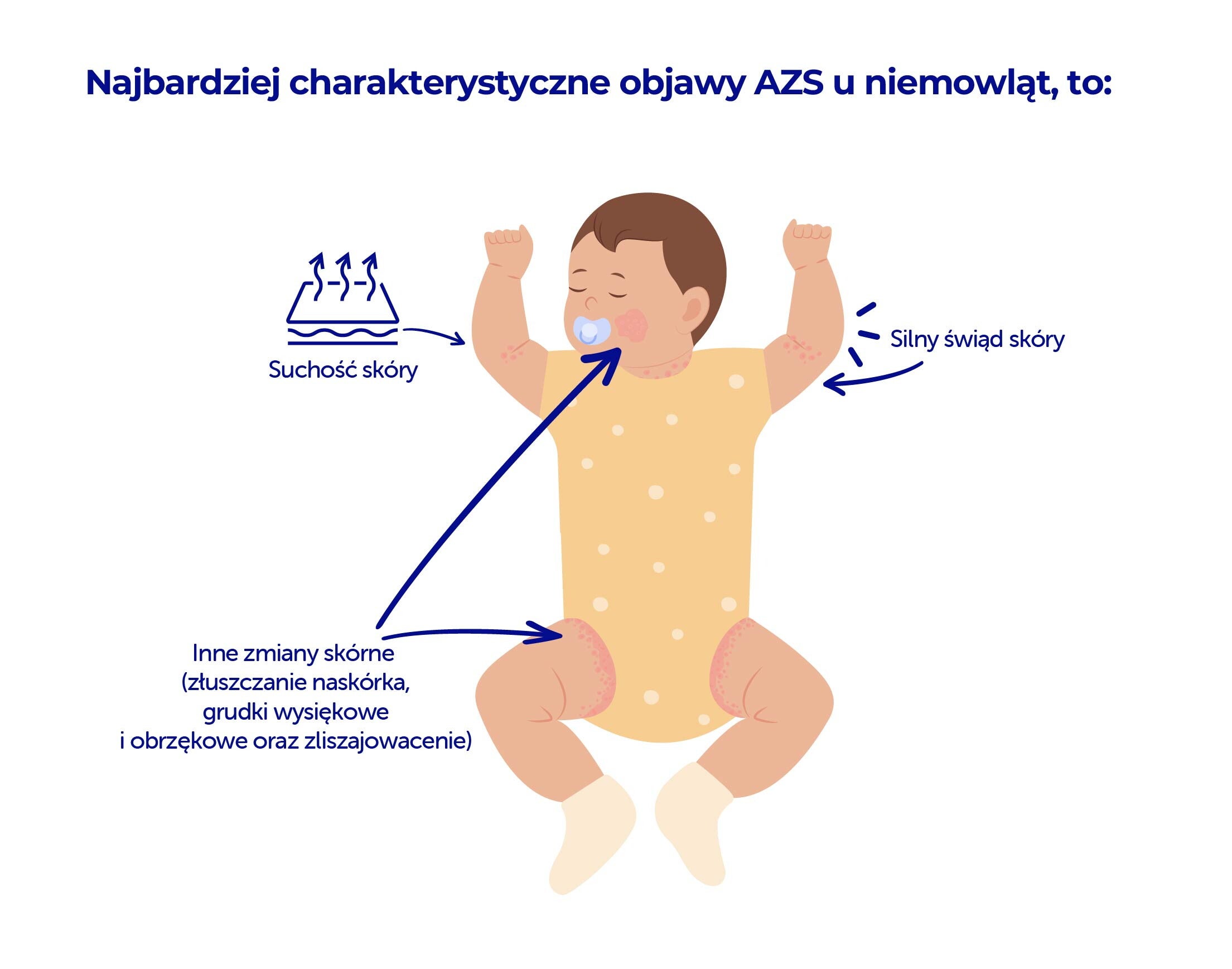 grafika pokazująca najbardziej charakterystyczne objawy AZS u niemowląt