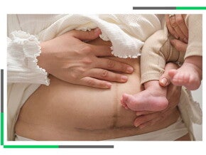 Brzuch kobiety po porodzie z widoczną kresą ciemną, trzymającej niemowlę