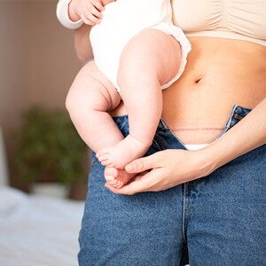 dziecko na rękach u mamy z odsłoniętą blizną po cięciu cesarskim